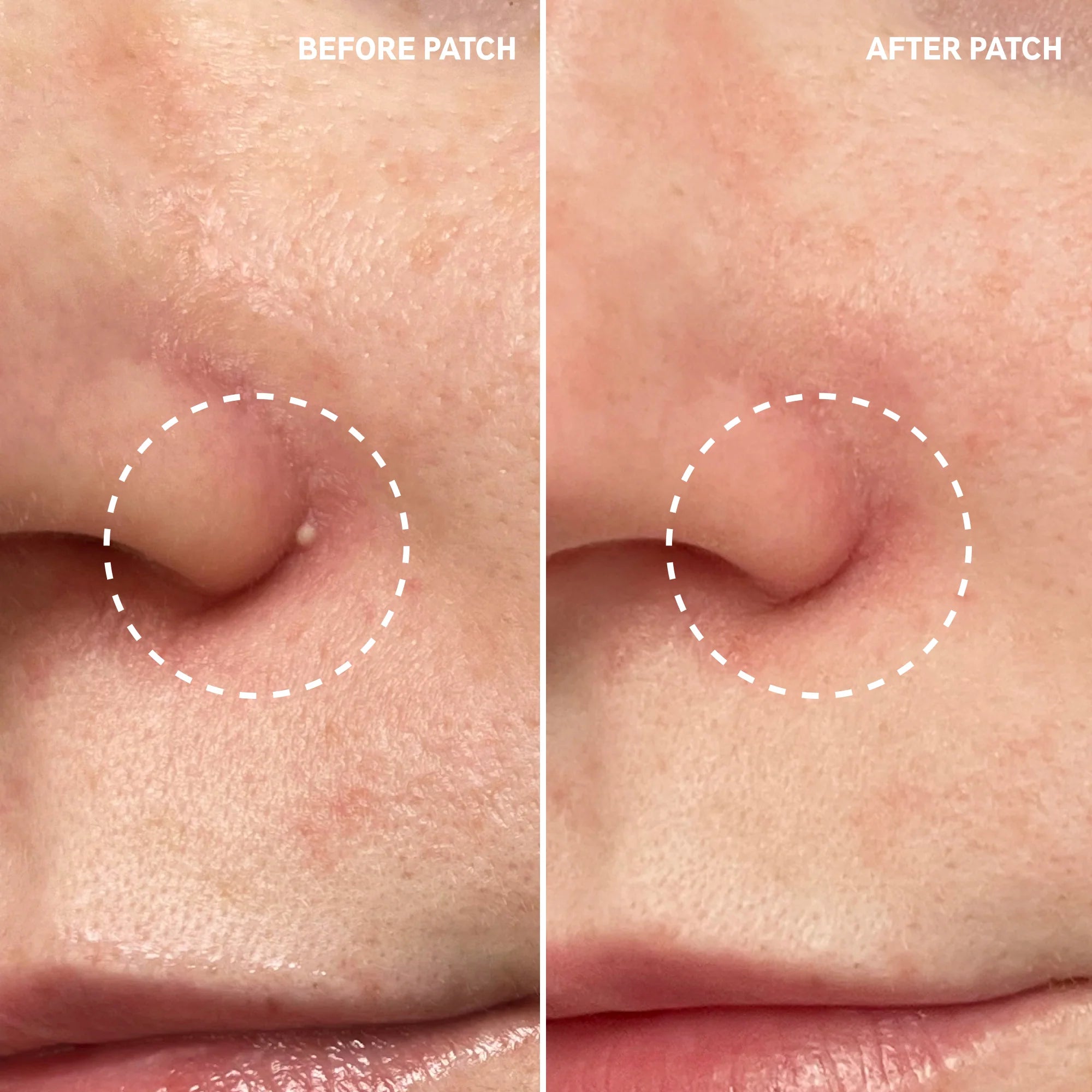 Hydrocolloid Invisible Pimple Patches